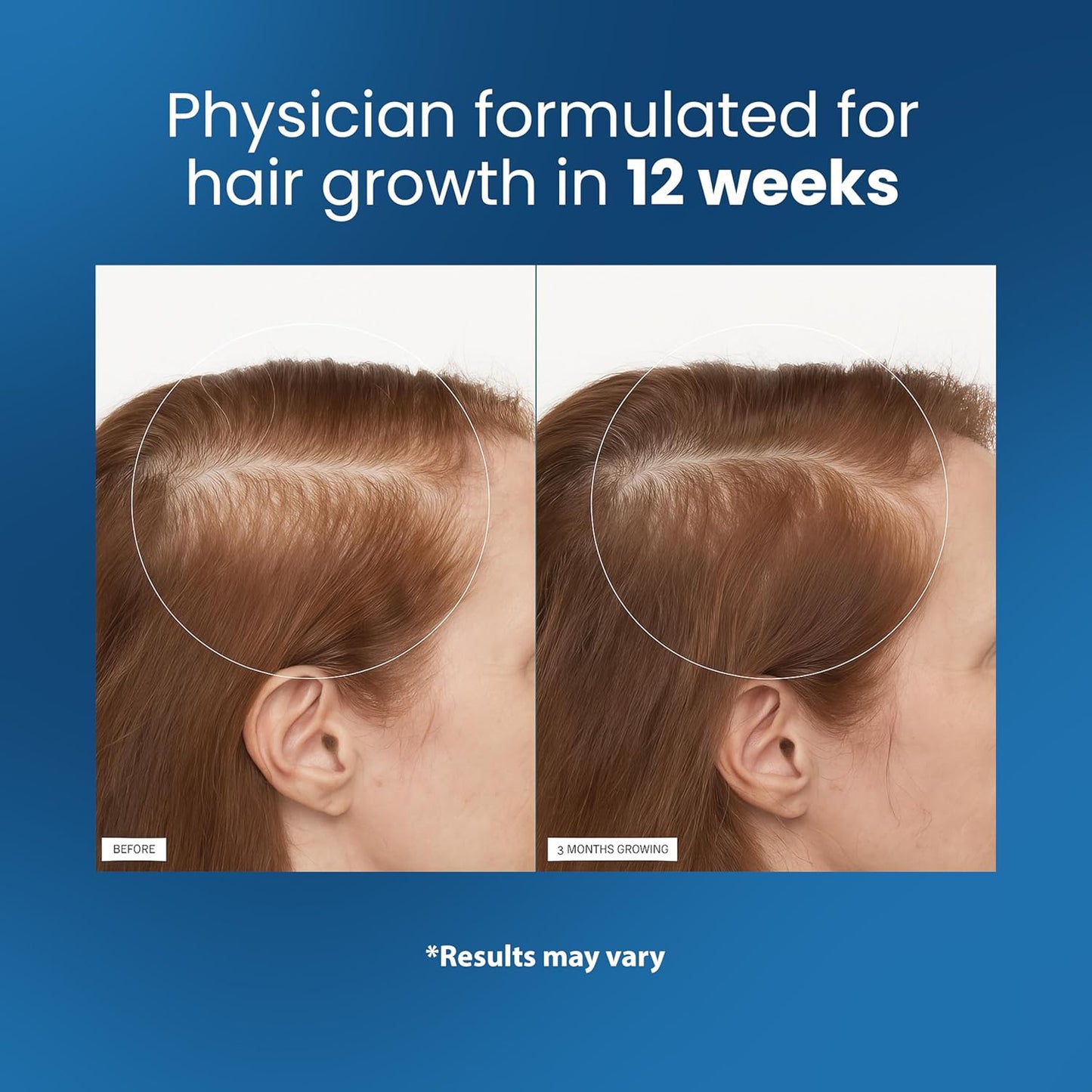 📢💥💥Final 5 Hours 54% OFF🔥Rosemary Hair Growth Serum Roll On 👩👦