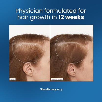 📢💥💥Final 5 Hours 54% OFF🔥Rosemary Hair Growth Serum Roll On 👩👦